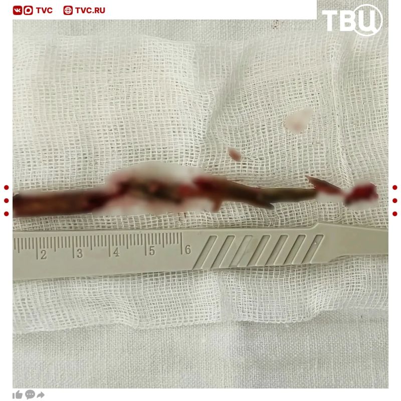 Мужчина полтора года жил с 12-сантиметровой веткой в голове в Курской области Мужчина полтора года жил с 12-сантиметровой веткой в голове в Курской области